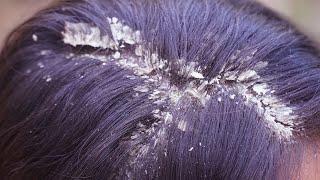 My Favorite Watch Dandruff Scratching Videos With Soft ASMR Hair Scalp Check up #164