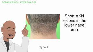 Bumpinator Laser Weapon Terminates Back of Head Razor Bumps Acne Keloidalis Nuchae AKN Permanently