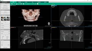 Software Ez3D-i : EZ SINUS e seni mascellari