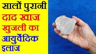 खाज खुजली के लिए घरेलू नुस्खा, Khaj Khujli Ka ilaj, khujli ki dawa, How To Cure itching