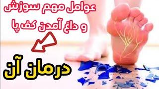 عوامل مهم سوزش و داغ امدن کف پا| burning feet and it’s treatment |