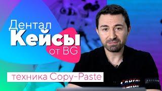 Дентал Кейсы от BG. Эстетическая реабилитация в технике Copy-Paste. #01