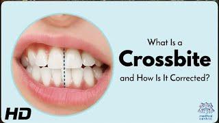 Crossbite 101: Symptoms, Causes & Best Treatment Options