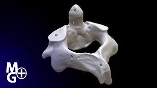 Vertebra C2 Axisul (Prezentare 3D- Anatomie)