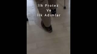 DİZALTI PROTEZ-BACAK PROTEZİ-VAKUMLU PROTEZ-PROTEZ BACAK-AKTİF VAKUM PROTEZ-SİLİKON PROTEZ