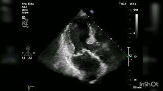 A case of Barlow disease with coexistent hypertrophic non-obstructive cardiomyopathy