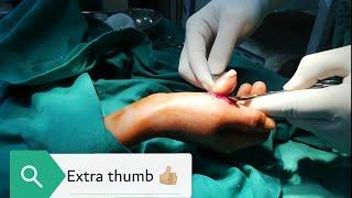 Extra thumb amputation| supernumerary digit| surgery| medico mnemonico