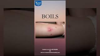 Boils-Best homeopathy treatment Drkukreja kalani online consultation 8291492566