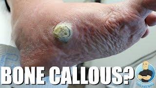 HUGE CALLOUS DUE TO COLLAPSED ARCH ***EXTREME CALLOUS REMOVAL***