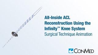 All-Inside ACL Reconstruction Using the Infinity™ Knee System - CONMED Animation