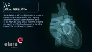 Atrial Fibrillation Cardiac Arrhythmia - 3D Animation