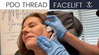 PDO Thread Lift for Face and Neck