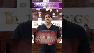 மேல் பல்லின் நடுவே இடைவெளி உள்ளதா? Midline diastema closure options | Dr.Karthikeyan