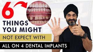 6 Things You Might Not Expect With All on 4 Dental Implants or a full mouth of dental implants