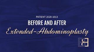 Extended Abdominoplasty After Loosing 34kg of Weight {Patient 2020-1013} Before & After