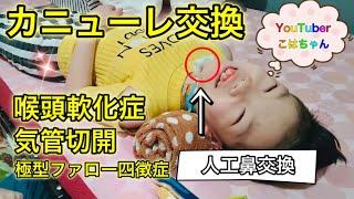 気管切開児こはちゃんのケア/物品紹介/カニューレ交換/人工鼻交換/カニューレバンド交換/医療的ケア児【全字幕付き】