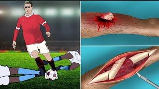 ASMR Surgery Trauma Leg FOOTBALL Give Cristiano Ronaldo - Animation Surgery