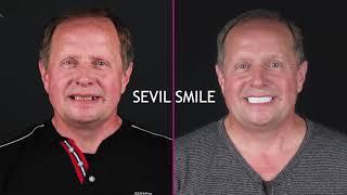 Dental Implant Surgery at Sevil Smile Antalya Turkey with Astra Tech