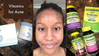 Vitamins I Take for my Hormonal Acne + Zitsticka Skin Discipline 3 month Update