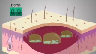 Vídeo explicativo sobre los Biofilms y como actúa Prontosan