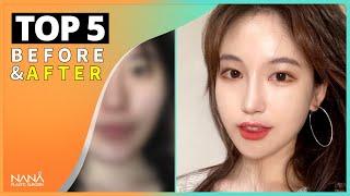 [SUB] TOP 5 Facial Plastic Surgery Before and After | NANA Plastic Surgery Hospital in Korea