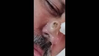 Penghilang Belatung Botfly #spa #dokter #memuaskan #jerawat #penghapusan