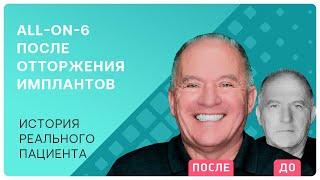 Что делать, если не прижились импланты? Делюсь опытом и тем, как избежать ошибок!