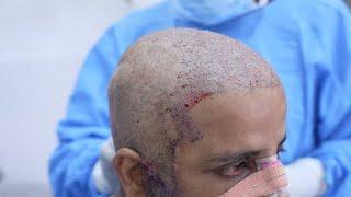 Step by Step FUE Hair Transplant Surgery in India | Richardson Face Hospital