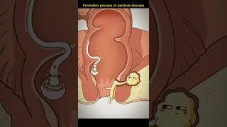Process of perianal abscess