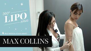 Max tries 360° Liposuction | Belo Medical Group