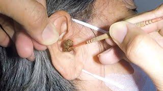 Longest Ear Wax Removal