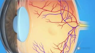 What is cystoid macular edema?