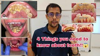 why should I get tooth cleaning!? || teeth cleaning || scaling myths busted