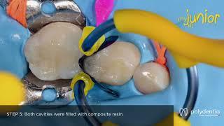 Restoration of a primary molar with myClip Junior. Clinical Case by Dr. Marina Papachroni