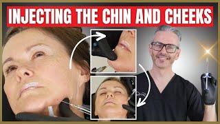 Injection Techniques | Dermal Filler Chin & Cheek Tutorial