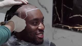 @P2istheName  Hair Transplant Journey at Heva Clinic: A Comprehensive Review" #afrohair @P2istheName