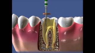 Пломбирование корневых каналов зуба