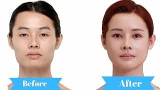 Facial Feminisation Transformation | Seoul Guide Medical