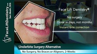 Correct Underbites - No Surgery, No Braces