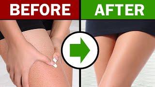 How to Get Rid of Strawberry Legs (Tips, Remedies, and Best Products)