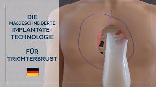 [DE] Die maßgeschneiderte Implantate-Technologie für Trichterbrust