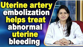 Uterine artery embolization helps treat abnormal uterine bleeding