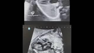 abnormal and normal fetal heart