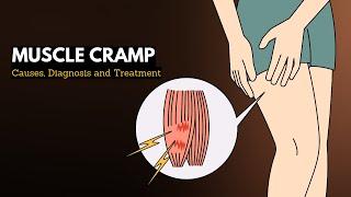 Muscle cramp, Causes, Signs and Symptoms, Diagnosis and Treatment.