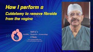 How I perform a culdotomy to remove fibroids from the vagina