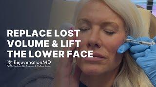 How Can I Lift the Lower Part of My Face?