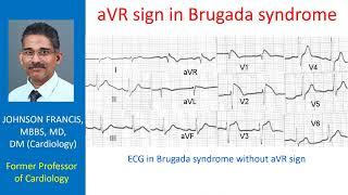 aVR sign in Brugada syndrome