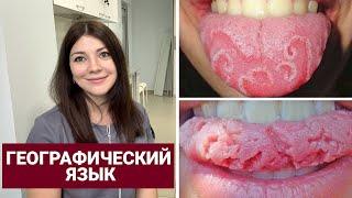 How to treat geographic tongue?