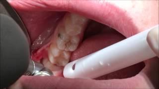Surgical extraction of horizontally impacted 38. Wisdom tooth extraction Ipswich