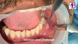 Incision and Drainage of Tooth Abscess Draining Pus